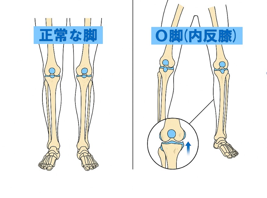 O脚による関節の痛みでお困りの方必見！｜瞬楽道の施術をぜひご体感ください